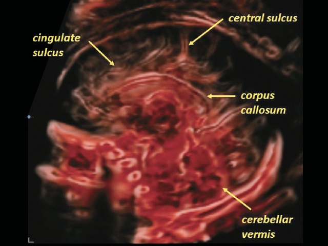 Эхограмма головного мозга плода - срединная сагиттальная проекция (режим CrystalVue™ и RealisticVue™)