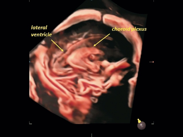 Эхограмма стенки бокового желудочка и хороидного сплетения у плода - парасагиттальная проекция (режим CrystalVue™ и RealisticVue™)
