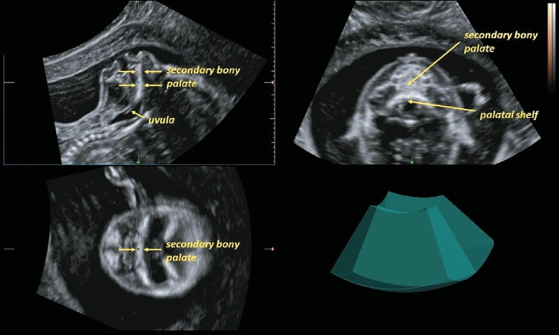 Эхограмма лица плода - многоплоскостная визуализация вторичного нёба