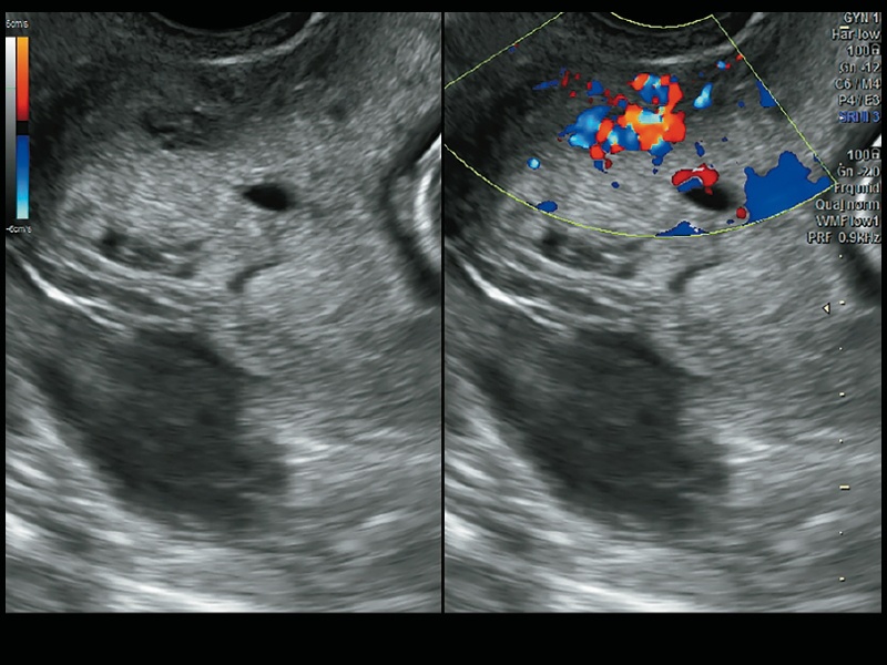 Эхограмма фрагментарного отсутствия эхотени мометрия, гипо-, анэхогенные структуры неправильной формы; ЦДК-режим: сосудистые маточно-плацентарные лакуны