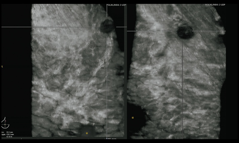 ЗИ пациентки Ч, режим ABVS (верхняя проекция, сосок визуализируется по нижнему краю изображения и верхнемедиальная проекция, сосок визуализируется в левом нижнем углу изображения)