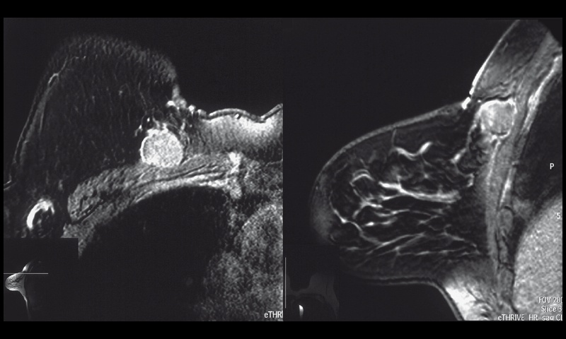 Магнитно-резонанная маммография с контрастированием пациентки Ч