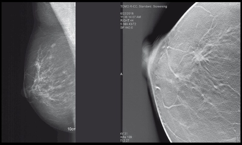 Рентгеновская маммография и томосинтез правой молочной железы пациентки М
