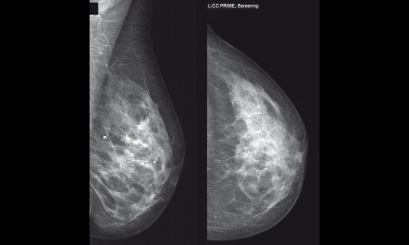 Рентгеновская маммография левой молочной железы пациентки Т, плотный фон
