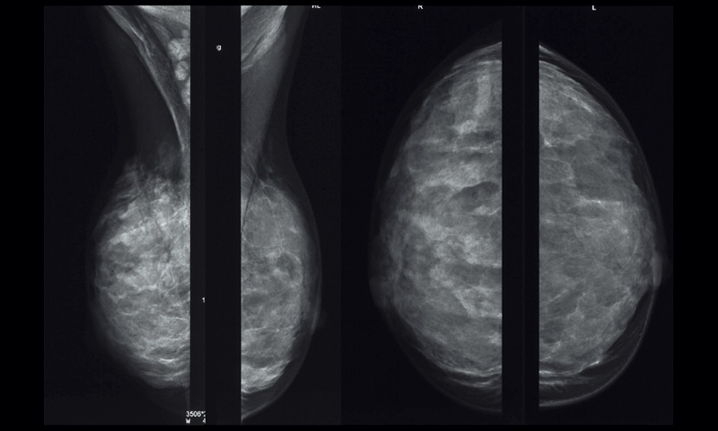 Маммография пациентки Ш