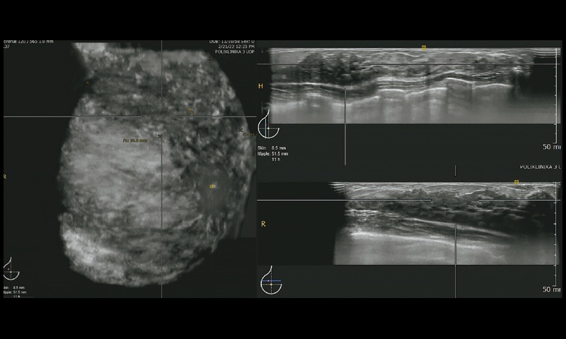 УЗИ правой молочной железы пациентки Ш, режим ABVS, сагиттальный, вертикальный и горизонтальный срезы