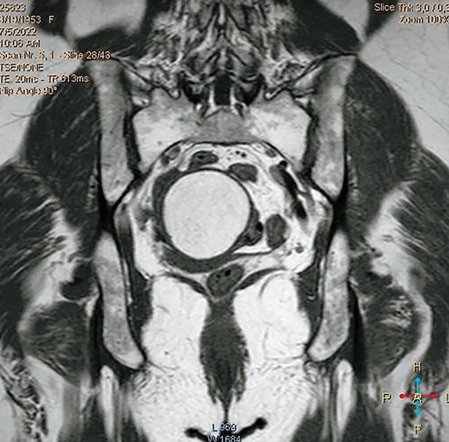 МРТ органов малого таза - фронтальное сечение