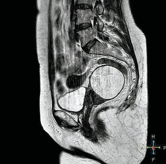 МРТ органов малого таза - сагиттальное сечение