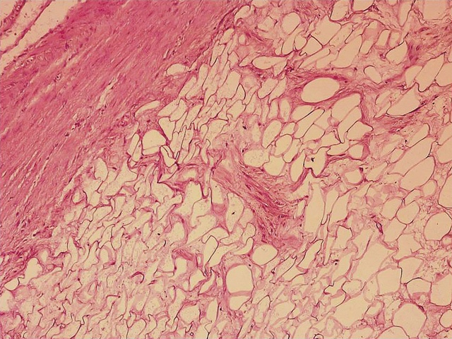 Микропрепарат липолейомиомы - окраска гематоксилин-эозином, х100