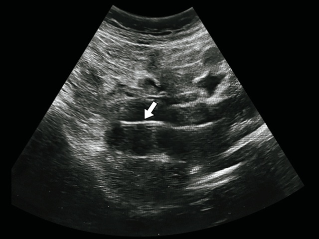 Ультразвуковая картина правильного расположения метрокольпостата (указан стрелкой) в полости матки