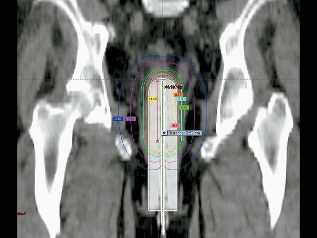 КТ - кольпостат расположен во влагалище, передняя проекция