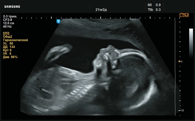 Эхограмма - микрогнатия (врождённая гипоплазия челюстной кости, 21 нед беременности)