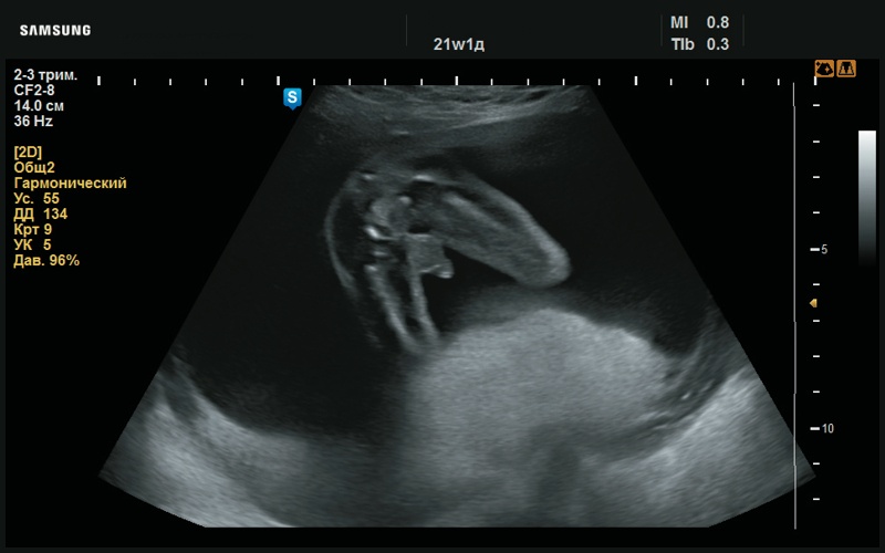 Эхограмма - мужской пол (21 нед беременности)