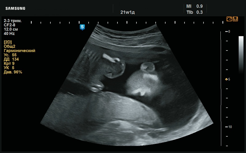 Эхограмма - сглаженный рисунок ушной раковины (21 нед беременности)