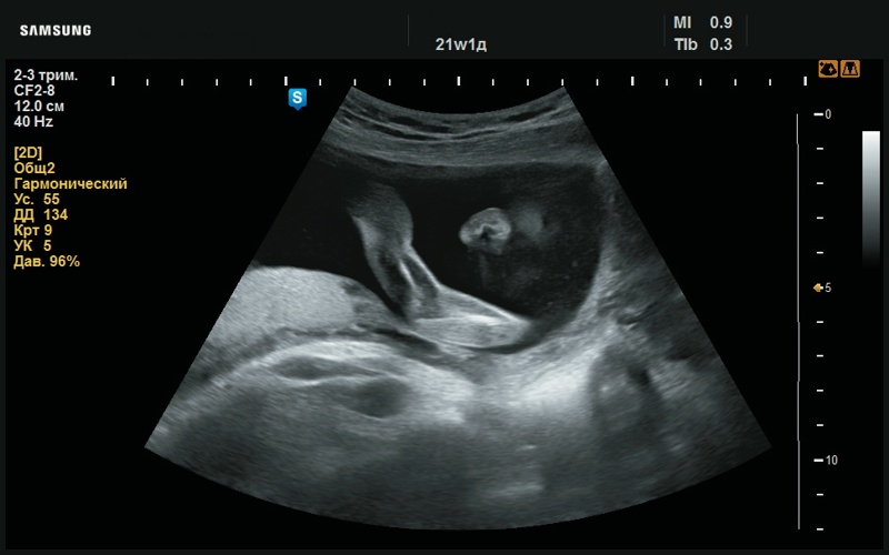 Эхограмма - сглаженный рисунок ушной раковины (21 нед беременности)