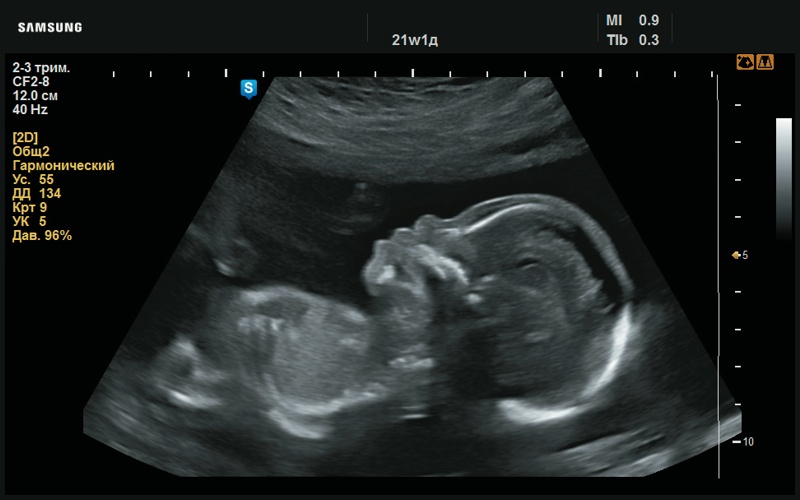 Эхограмма - плоский профиль (21 нед беременности)