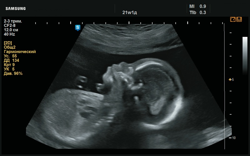 Эхограмма - низкая переносица (21 нед беременности)