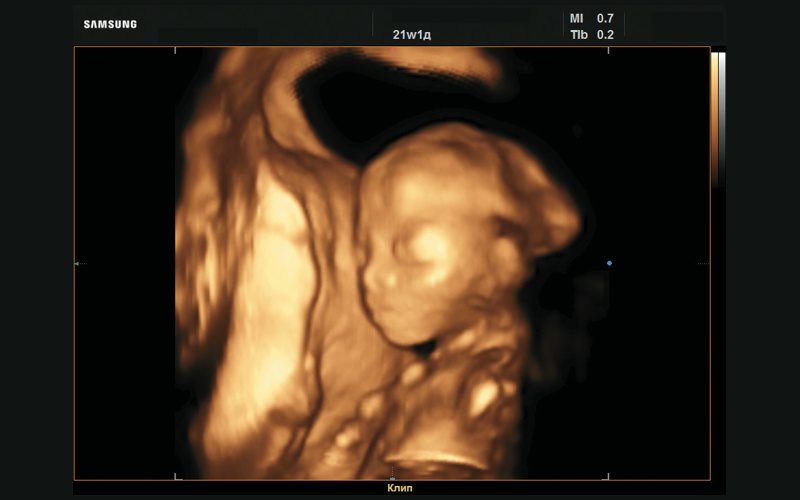Эхограмма - плоский профиль, 3D-реконструкция (21 нед беременности)