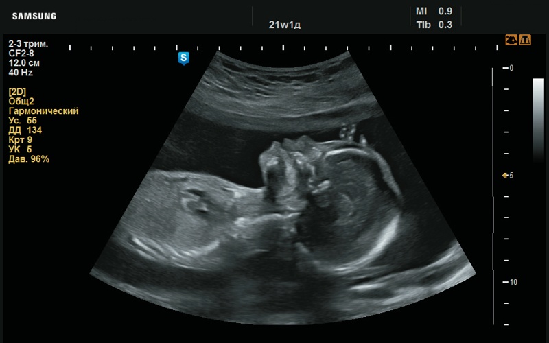 Эхограмма - макроглоссия (аномально большой язык, 21 нед беременности)
