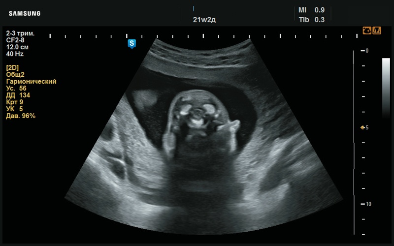 Эхограмма - отсутствие визуализации правой ушной раковины (21 нед беременности)