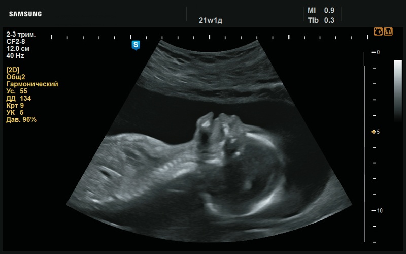 Эхограмма - макроглоссия (21 нед беременности)