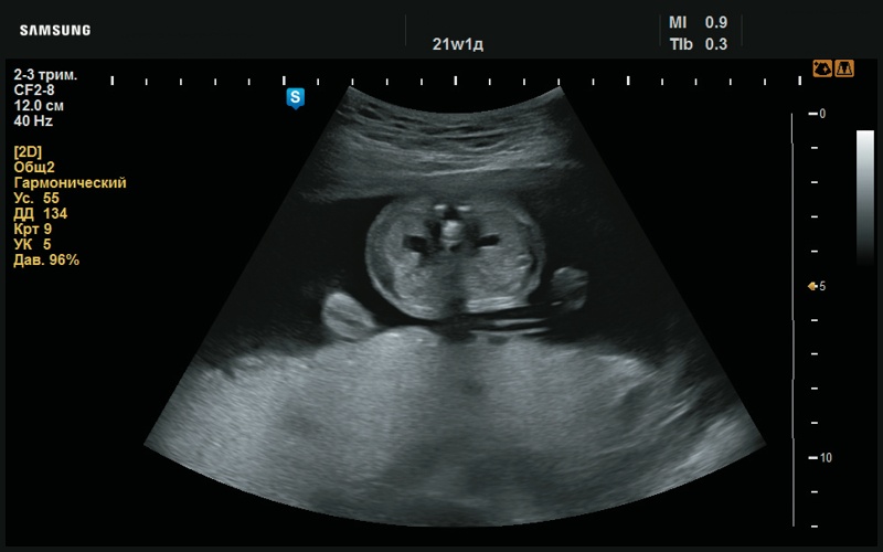 Эхограмма - умеренная пиелоэктазия (21 нед беременности)