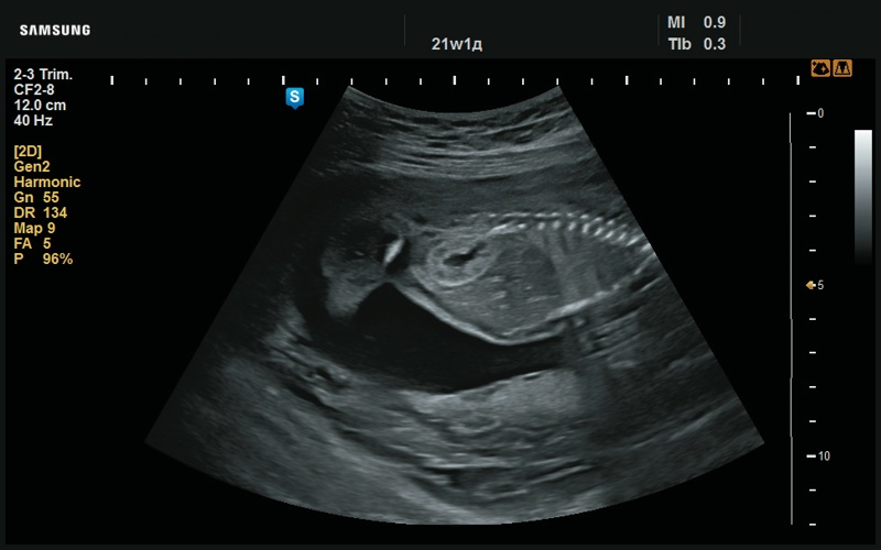 Эхограмма - повышенная эхогенность паренхимы почек (21 нед беременности)