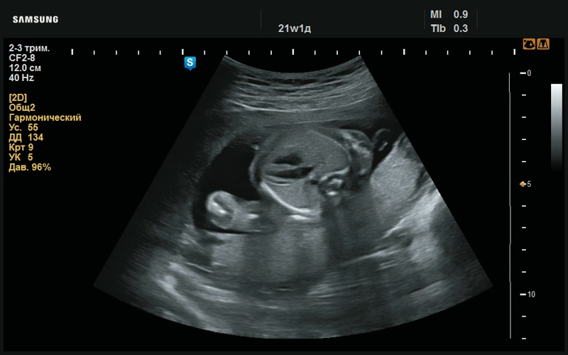 Эхограмма - четырехкамерное сердце, в норме (21 нед беременности)