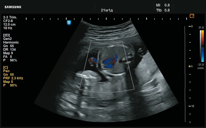 Эхограмма - отсутствие дефекта межжелудочковой перегородки (21 нед беременности)