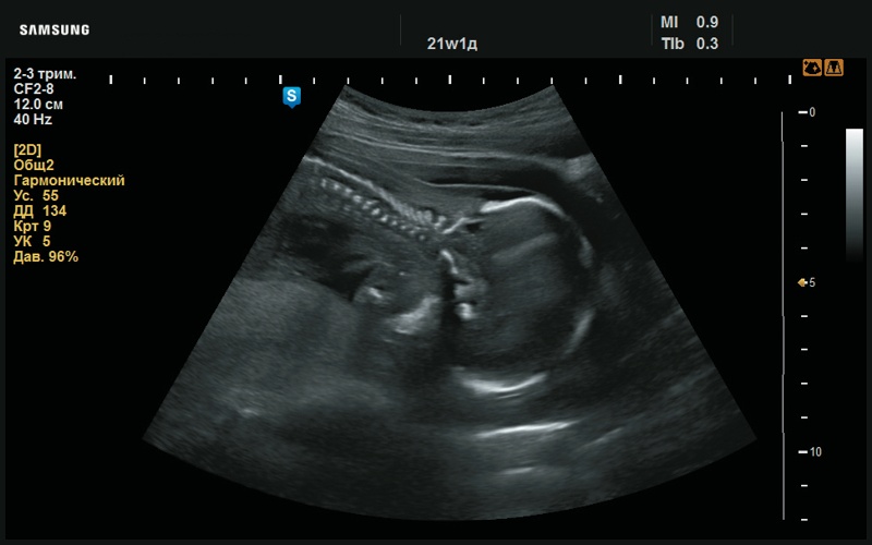 Эхограмма - утолщение шейной складки (21 нед беременности)