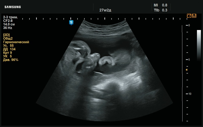 Эхограмма - сглаженный рисунок ушной раковины (27 нед беременности)