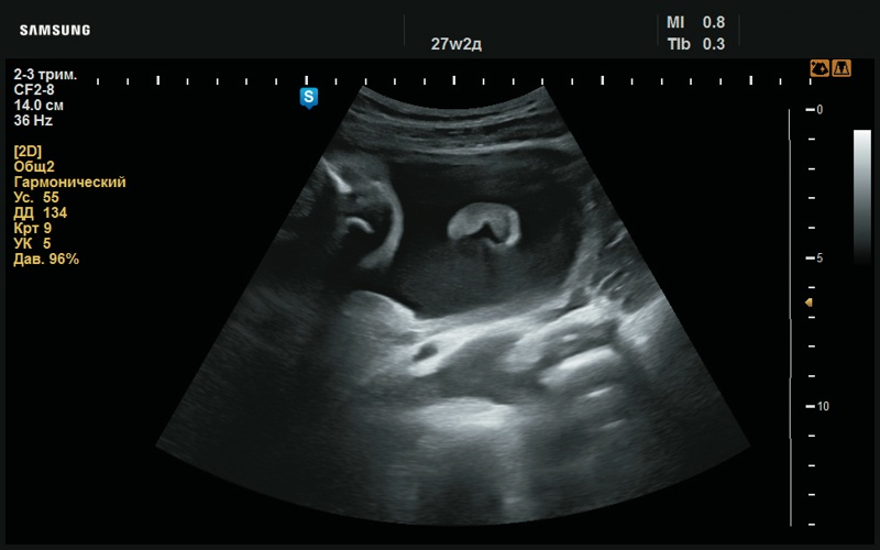 Эхограмма - сглаженный рисунок ушной раковины (27 нед беременности)