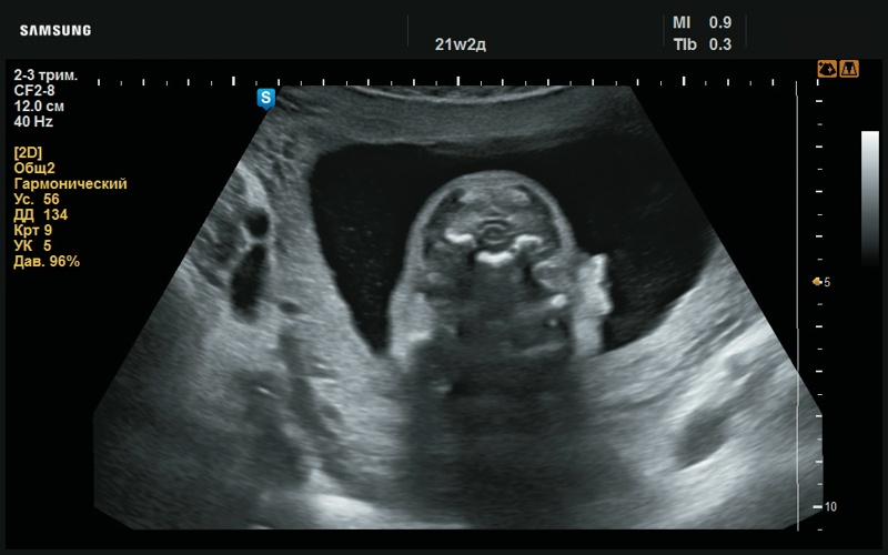 Эхограмма - асимметричное изображение ушных раковин в аксиальном срезе (21 нед беременности)