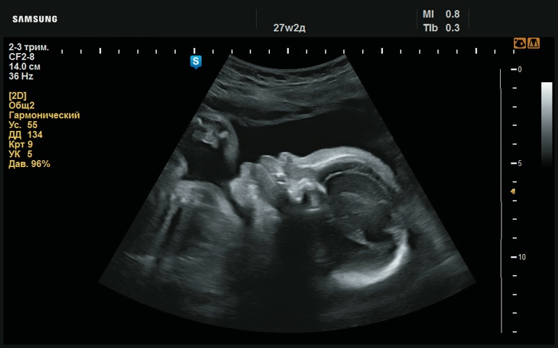 Эхограмма - плоский профиль с макроглоссией (27 нед беременности)
