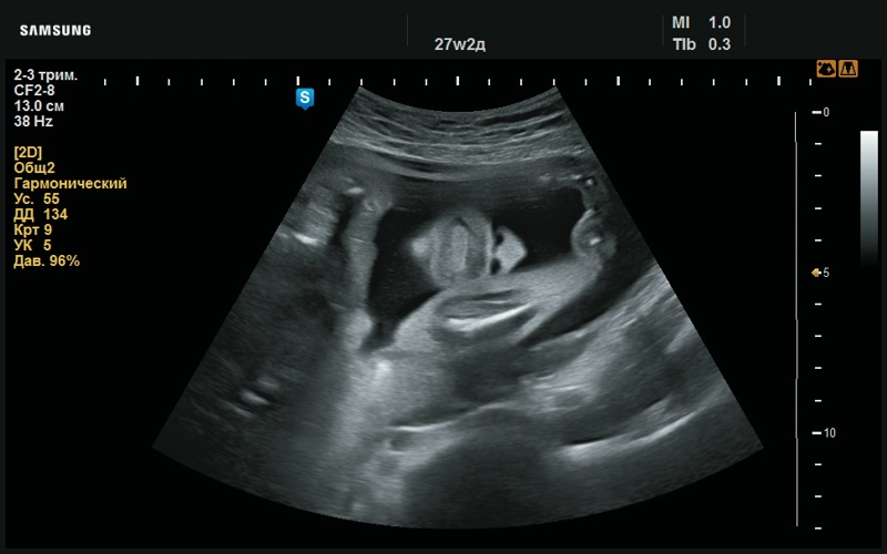 Эхограмма - макроглоссия (27 нед беременности)