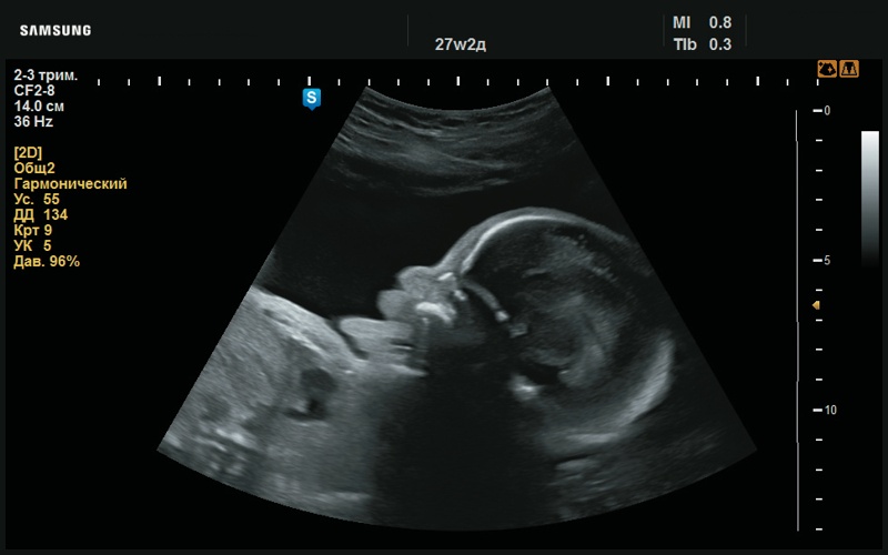 Эхограмма - высунутый язык (27 нед беременности)