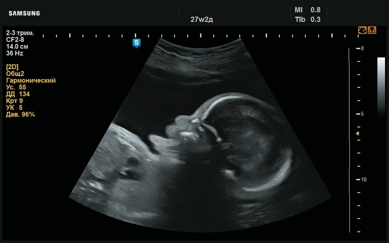 Эхограмма - высунутый язык (27 нед беременности)