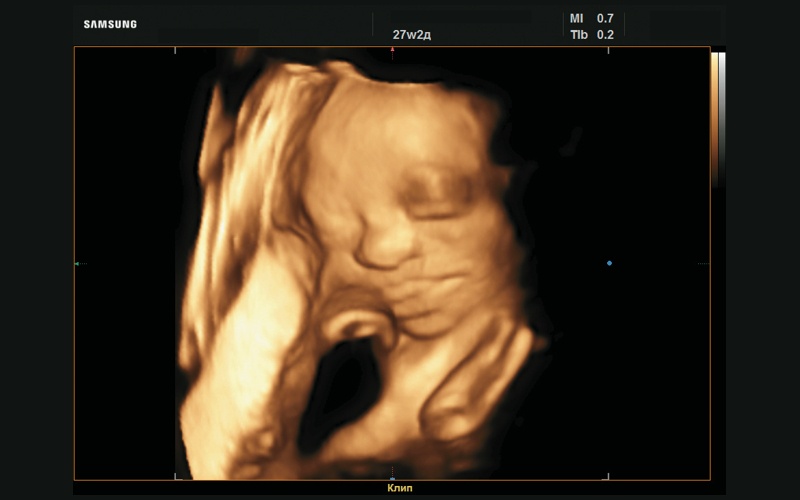 Эхограмма - макроглоссия, 3D-реконструкция (27 нед беременности)