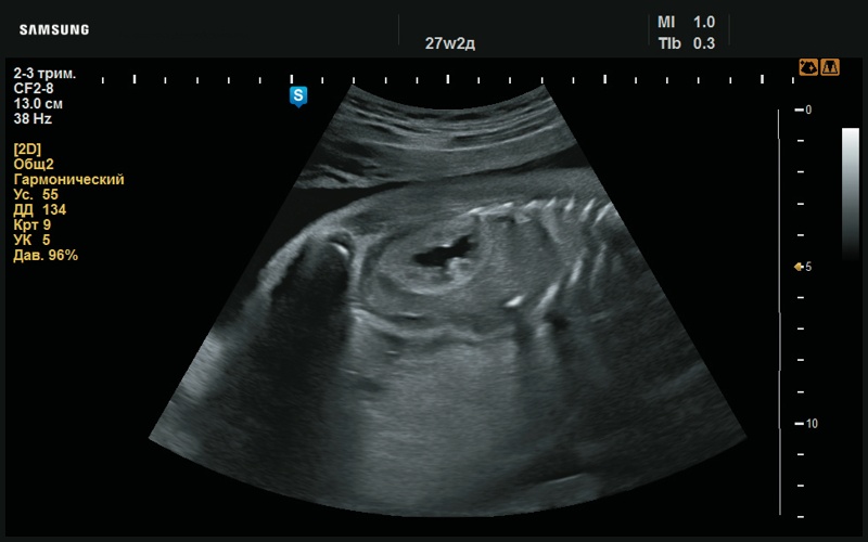 Эхограмма - повышенная эхогенность паренхимы почек (27 нед беременности)