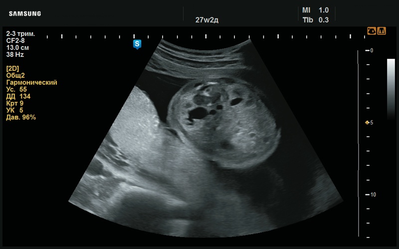 Эхограмма - пиелоэктазия (расширение лоханочной системы почки, 27 нед беременности)