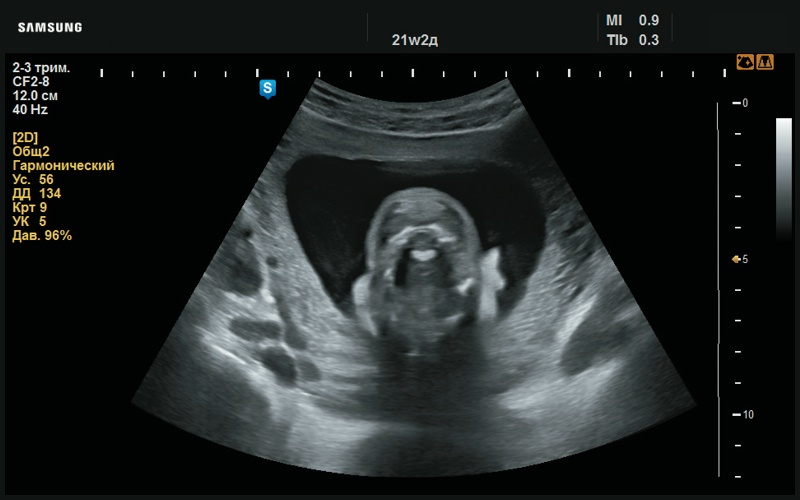 Эхограмма - отсутствие визуализации правой ушной раковины (21 нед беременности)