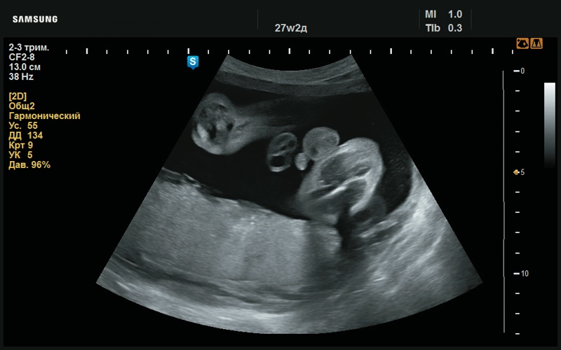 Эхограмма - мужской пол (27 нед беременности)
