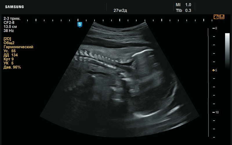 Эхограмма - утолщение шейной складки (27 нед беременности)