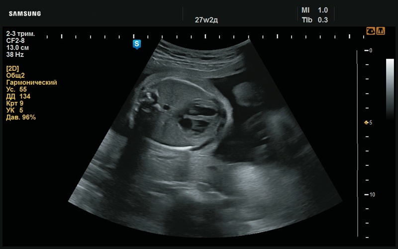 Эхограмма - правильно сформированное сердце, в норме (27 нед беременности)