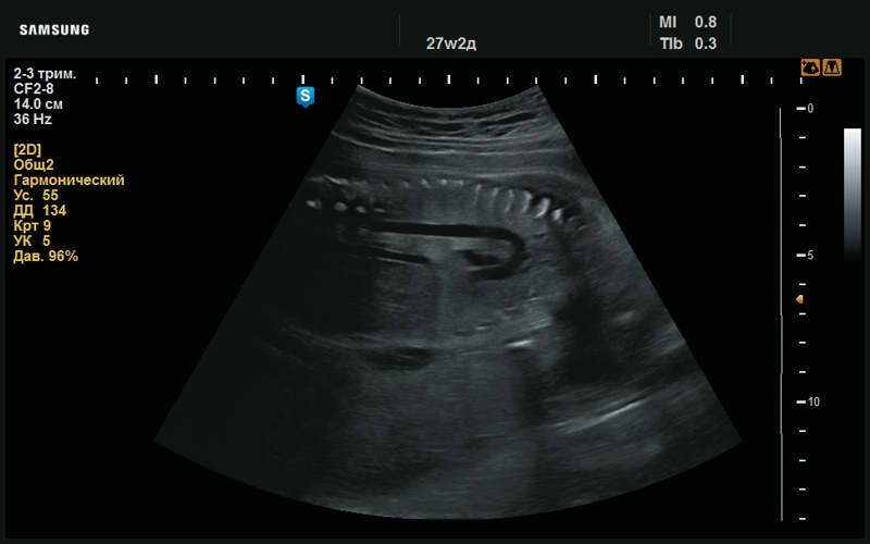 Эхограмма - дуга аорты, в норме (27 нед беременности)