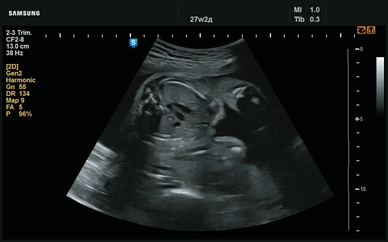 Эхограмма - срез через три сосуда, в норме (27 нед беременности)