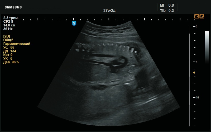 Эхограмма - дуга аорты и нижняя полая вена, в норме (27 нед беременности)