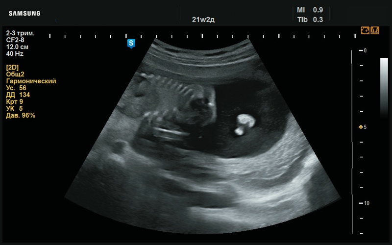Эхограмма - преаурикулярный вырост левой ушной раковины (21 нед беременности)