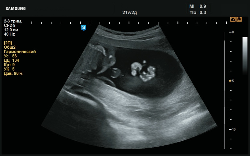 Эхограмма - преаурикулярный вырост левой ушной раковины (21 нед беременности)