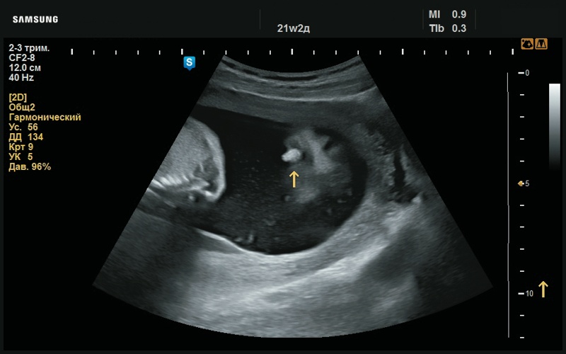 Эхограмма - рудимент правой ушной раковины (стрелка, 21 нед беременности)